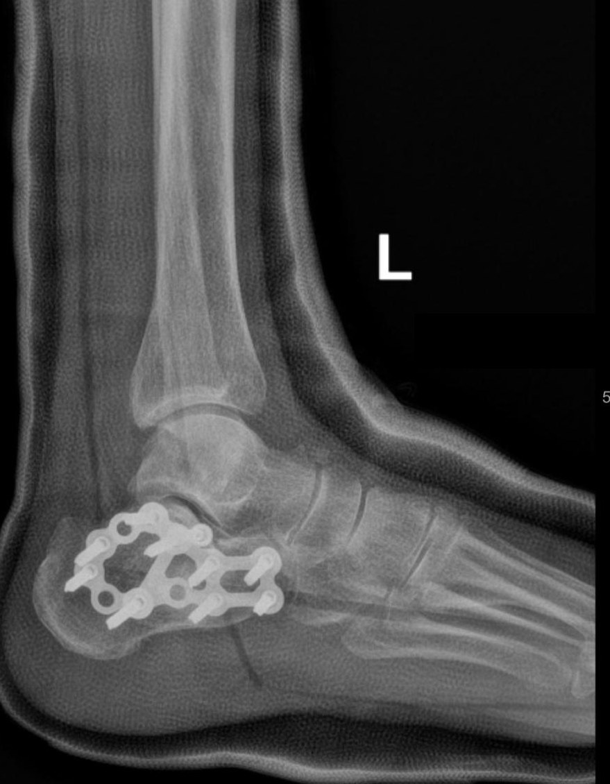 X-ray of a heel bone (calcaneus) fracture fixed with a plate
