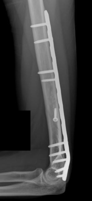 X-ray of a humerus shaft fracture fixed with a locking plate