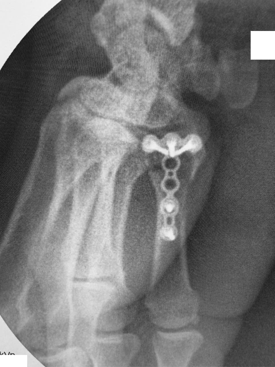 C-arm intra-operative view of fracture plate fixation