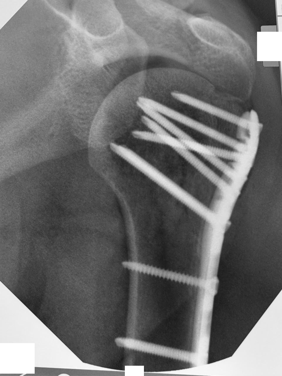 C-arm view of a shoulder fracture fixed with a locking plate and screws